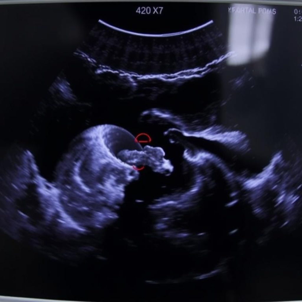 diagnosis Plasenta Previa dengan USG diagnosis Plasenta Previa dengan USG