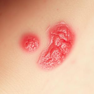 penyakit-Selulitis penyakit Selulitis